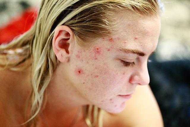 3 meilleurs conseils de soins de la peau contre l acne pour une peau plus saine