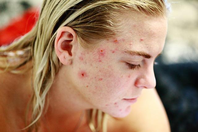 5 conseils de traitement de l acne que vous pouvez utiliser aujourd hui